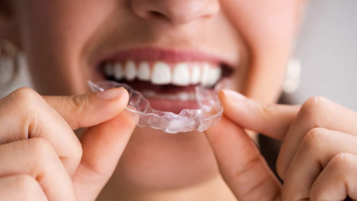 Aligners - Invisalign and Crystal Aligner