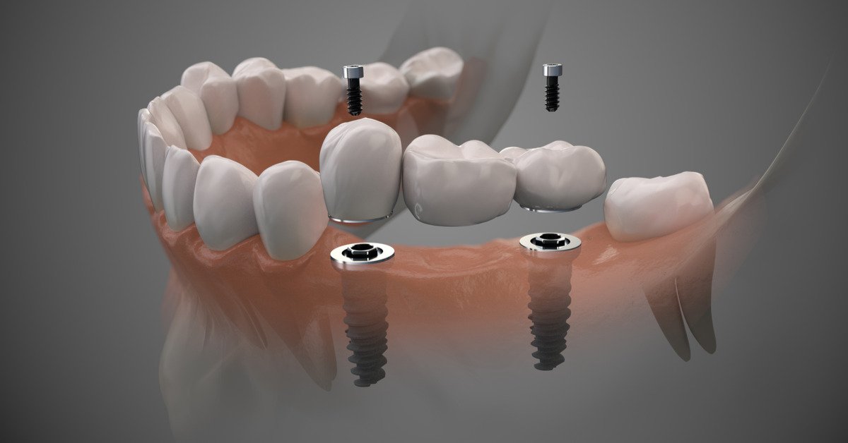 Digital Implantation